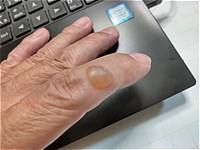 火傷でできた水ぶくれ